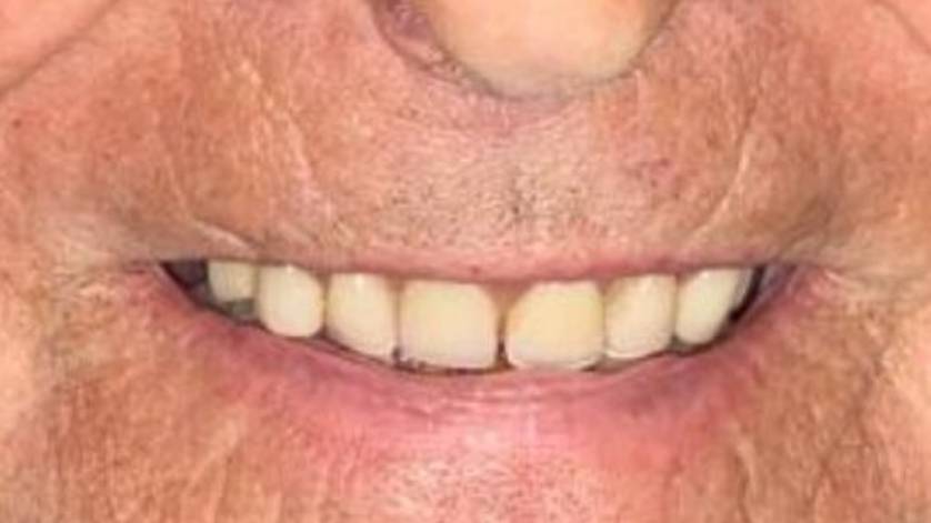 Clinical Case ALL-ON-4_-1