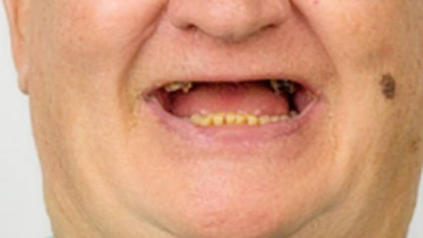 Clinical Case ALL-ON-4_3a