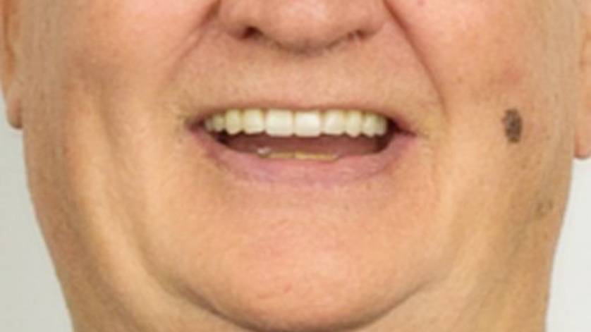 Clinical Case ALL-ON-4_3b