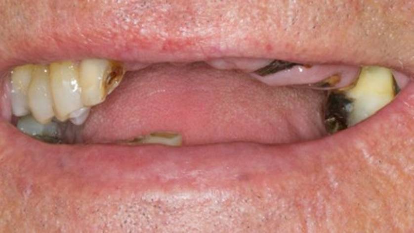 Clinical Case ALL-ON-4_4a