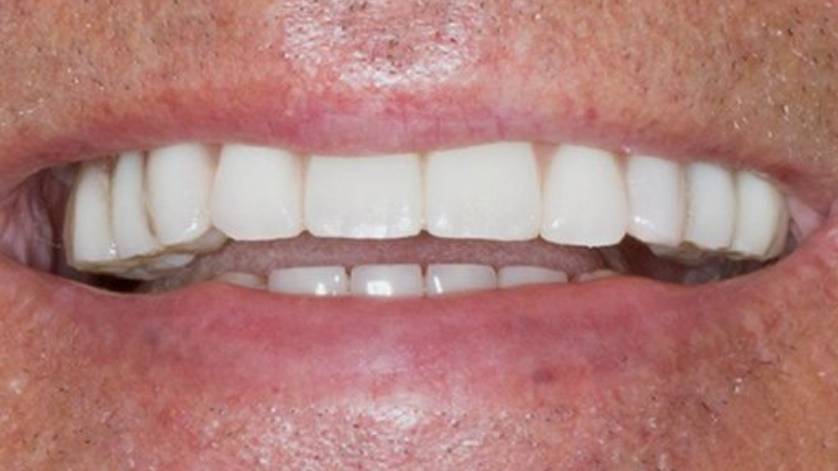 Clinical Case ALL-ON-4_4b