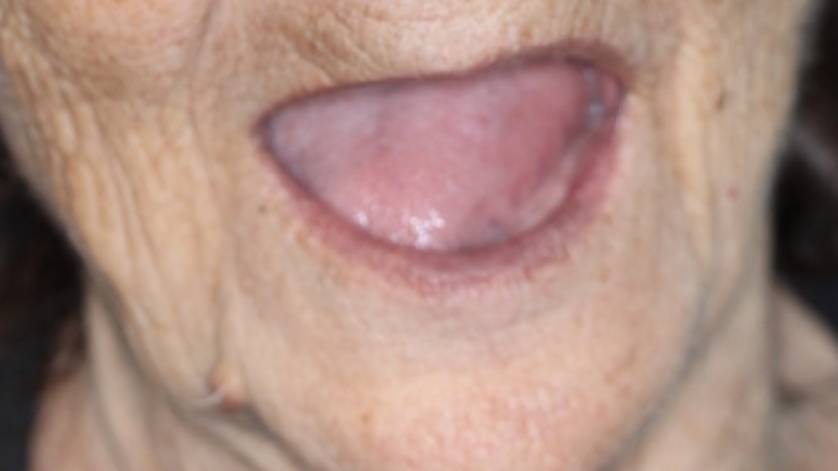 Clinical Case ALL-ON-4_5a