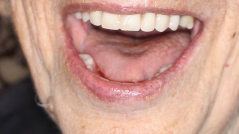 Clinical Case ALL-ON-4_5b