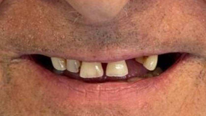 Clinical Case ALL-ON-4_6a