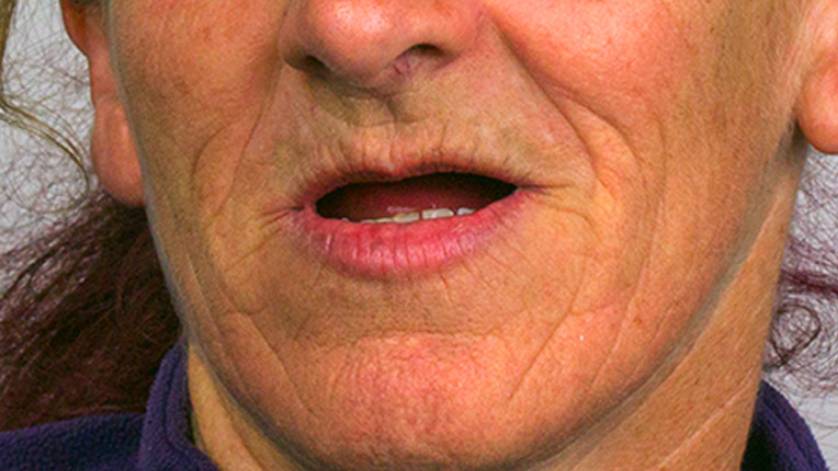 Clinical Case ALL-ON-4_8a