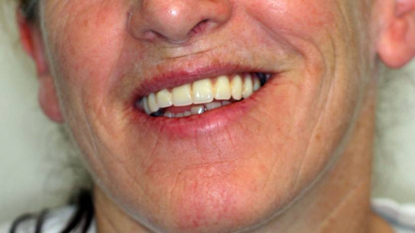 Clinical Case ALL-ON-4_8b