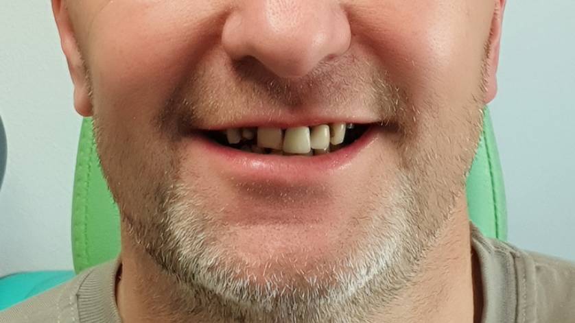 Clinical Case ALL-ON-4_9a