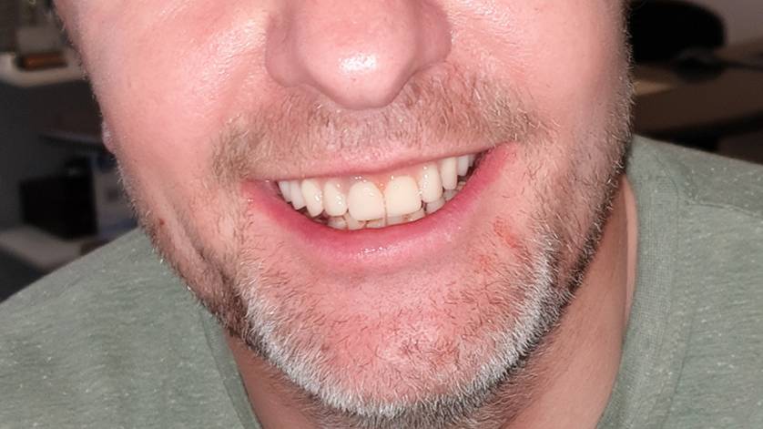 Clinical Case ALL-ON-4_9b