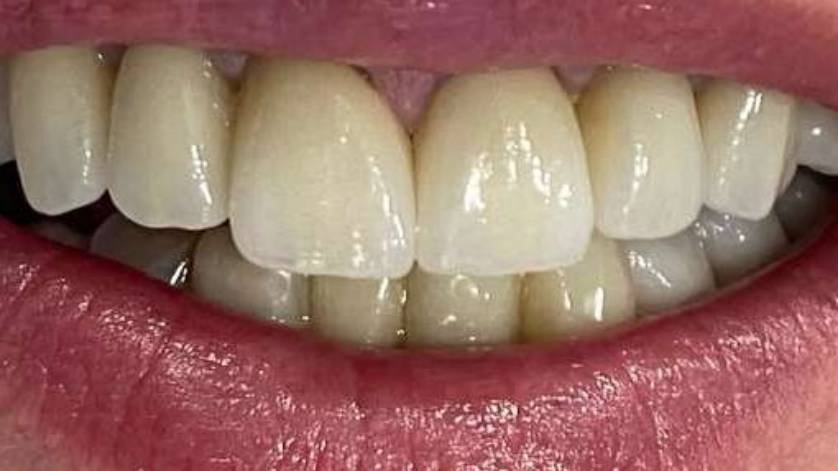 Clinical Case Dental Implants_6b