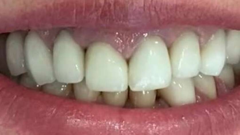 Clinical Case Dental Implants_7a