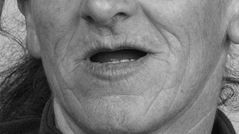 All-On-4 Technique_Clinical Case_1a