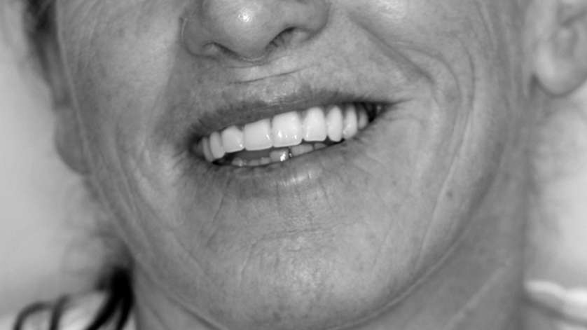 All-On-4 Technique_Clinical Case_1b