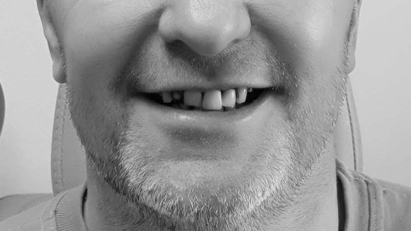 All-On-4 Technique_Clinical Case_2a