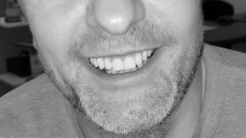 All-On-4 Technique_Clinical Case_2b